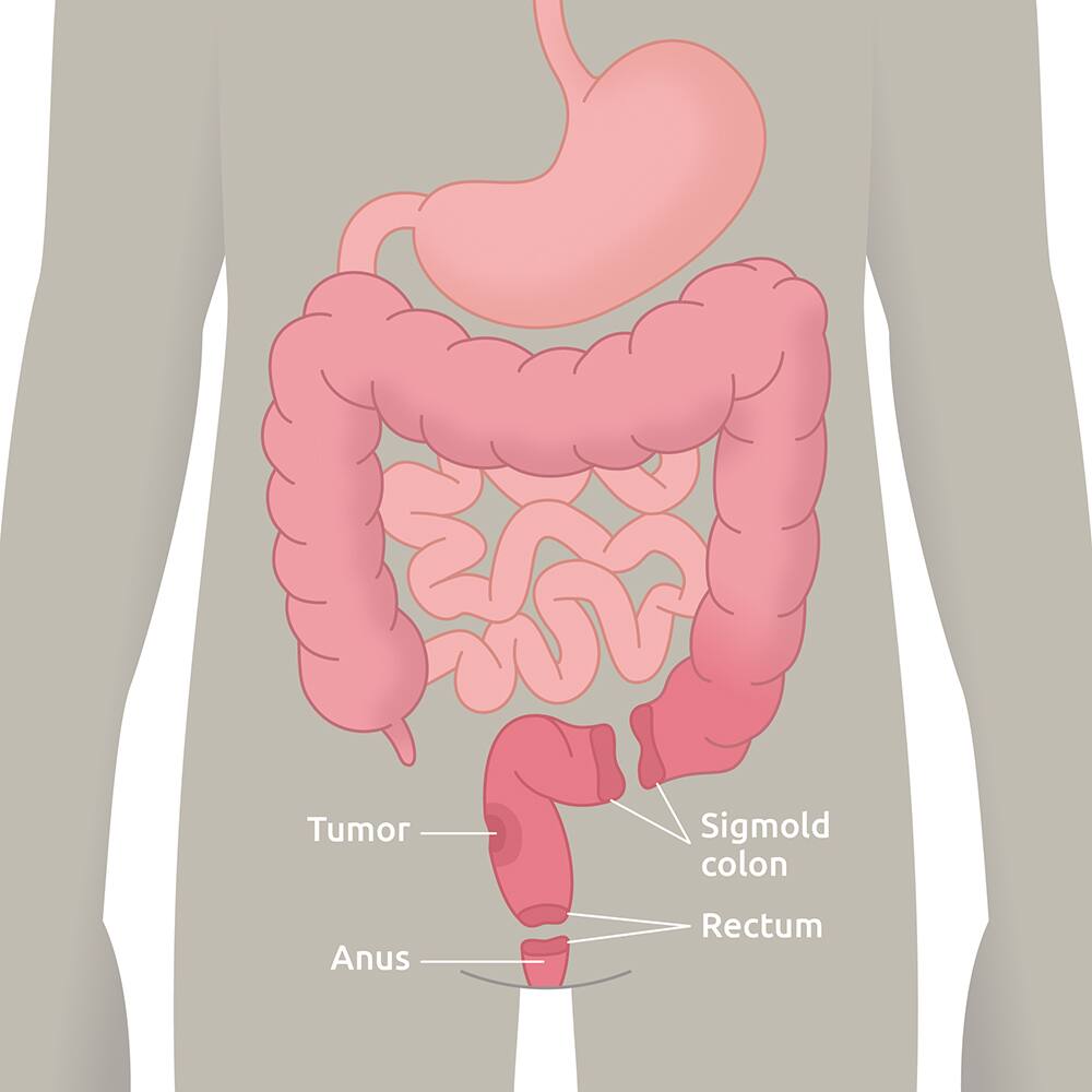 Lav Anterior Resektions Syndrom (LARS)​
