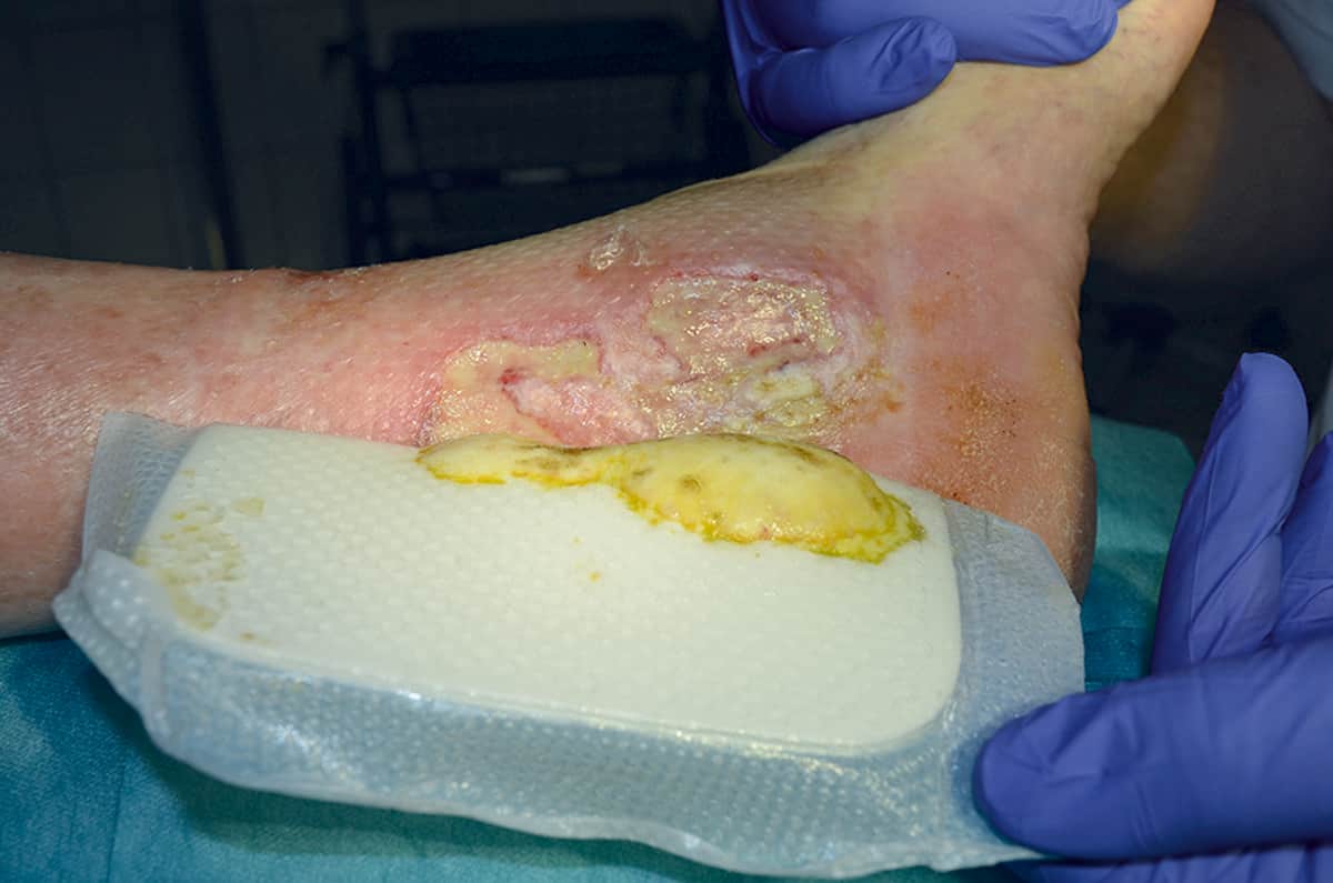 Hvad er en sølvbandage?