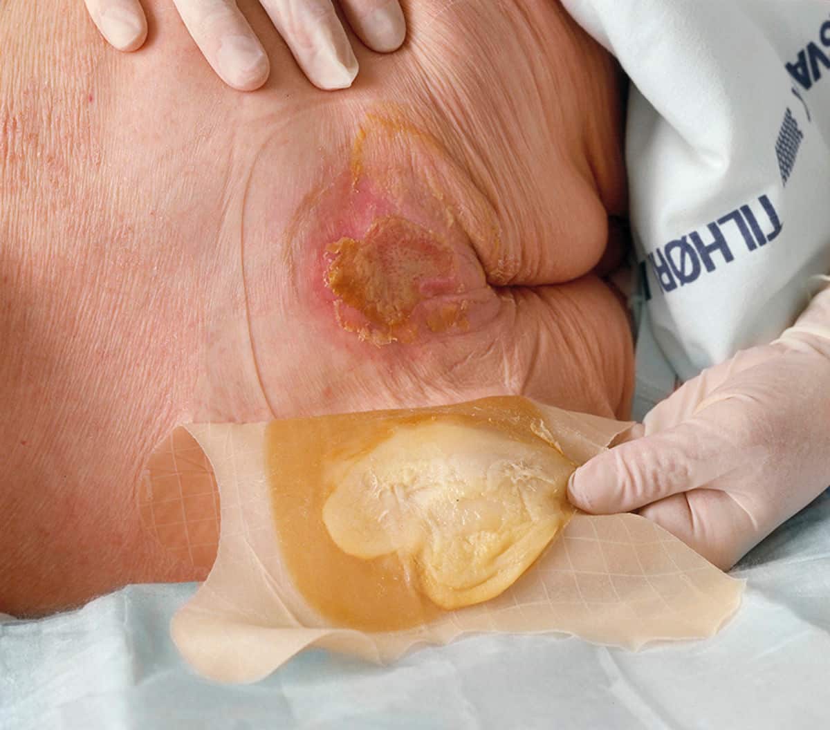 Her er nogle vigtige faktorer, du skal overveje, når du vælger en hydrokolloidbandage: