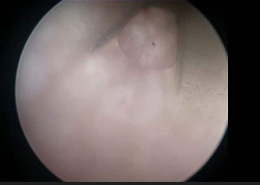 CEC seen from the inside of the catheter, OUH, DK